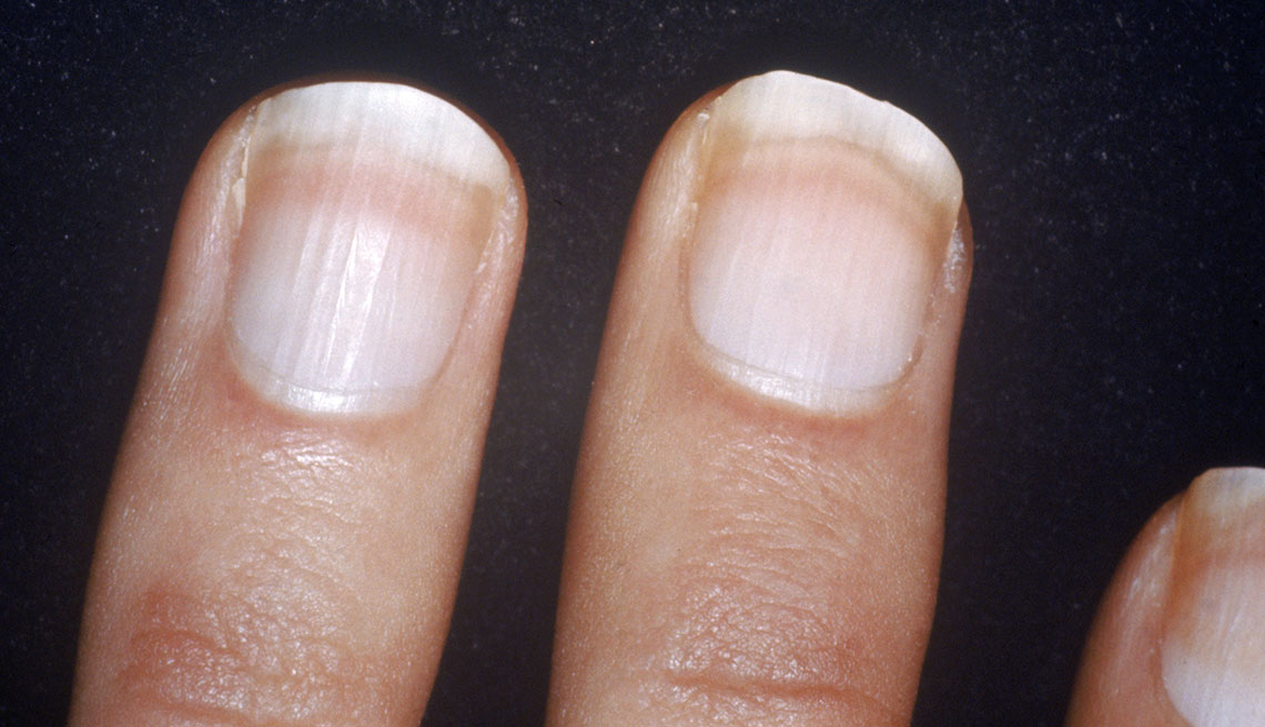 Why Do Your Fingernails Turn White