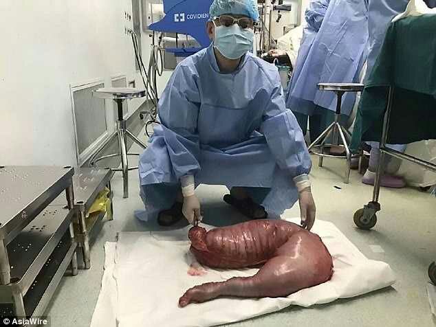 Chinese Doctors Remove 13Kg Of Stuck Poo From Man's Bowel After 22 Years