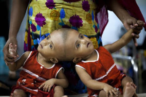 Conjoined Twin Girls Set To Be Separated