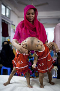 Conjoined Twin Girls Set To Be Separated