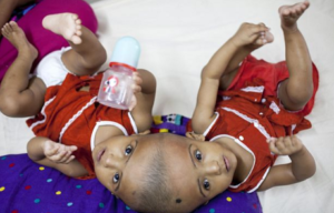 Conjoined Twin Girls Set To Be Separated