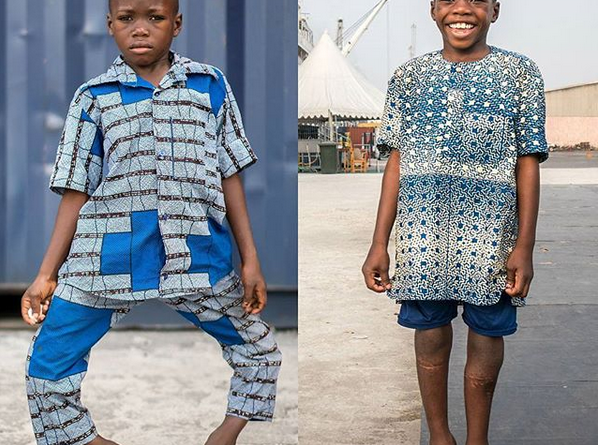 Young Boy With Bow Legs All Smiles After Undergoing Surgery